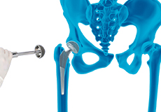 Robotic Total Hip Replacement