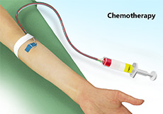 Chemotherapy