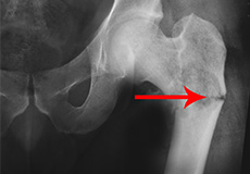 Fractures in Cancer Patients