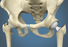 Hip Hemiarthroplasty