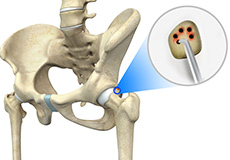 Hip Microfracture