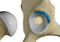 Hip Trauma Reconstruction