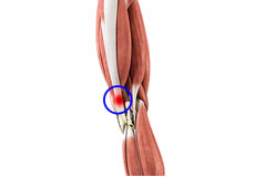 Iliotibial Band Syndrome