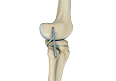 Knee Trauma Reconstruction
