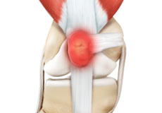 Kneecap Bursitis