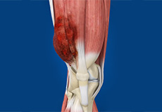 Malignant Bone and Soft Tissue Tumors