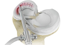 Meniscal Surgery