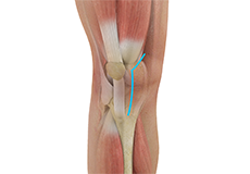 Muscle-sparing Knee Replacement 