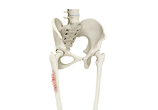 Musculoskeletal Tumors