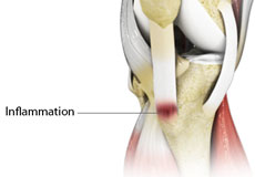 Osgood Schlatter Disease