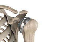 Unicompartmental/Partial Knee Replacement