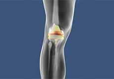 Patient Specific Knee Replacement