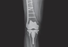Periprosthetic Knee Fracture Fixation