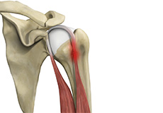 Proximal Biceps Tenodesis