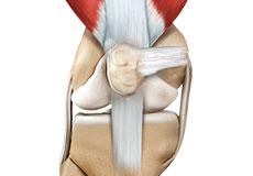 Quadriceps Tendon Repair