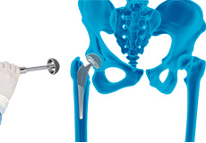 Robotic Anterior Total Hip Arthroplasty