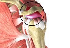 Shoulder Bursitis