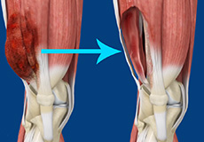 Soft Tissue Sarcoma Resection