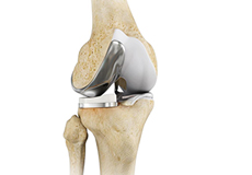 Unicompartmental/Partial Knee Replacement